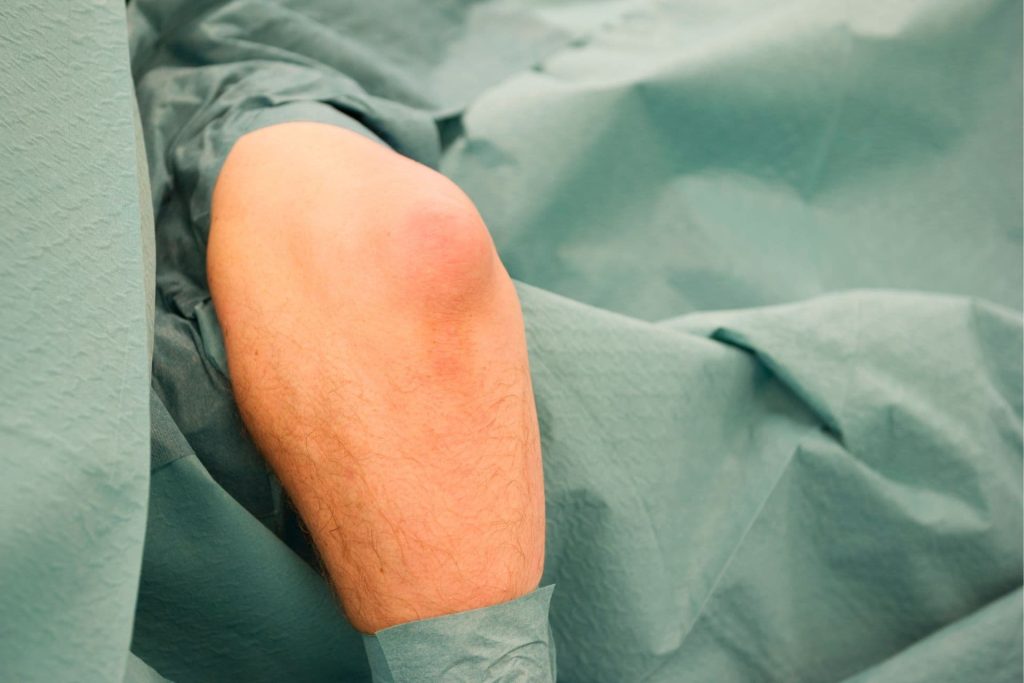 Könyök nyáktömlőgyulladás (olecranon bursitis)