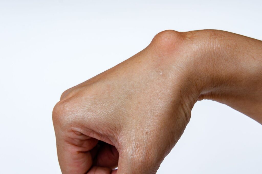 Ganglion ciszta